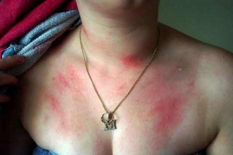 weird-diseases-allergic-to-water