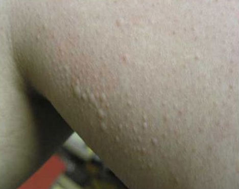 weird-diseases-cold-urticaria