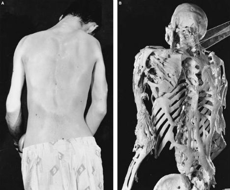 weird-diseases-fibrodysplasia