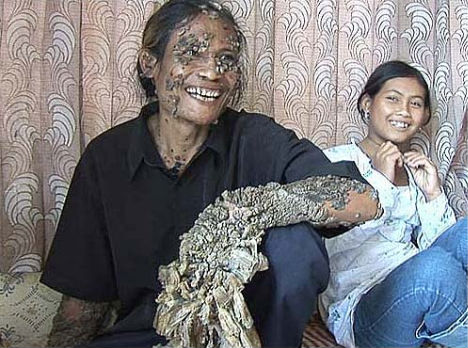 weird-diseases-tree-man